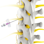 Transforaminal Epidural Block